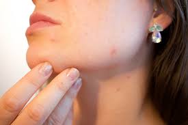 Was alle pickel jedoch gemeinsam haben: Kosmetik Blog Fur Medical Beauty Und Trends Aus Schonheit Haut