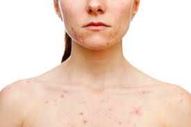 Image result for Neurotic Excoriation