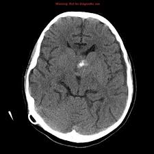 Glioblastoma Nos Radiology Case Radiopaedia Org