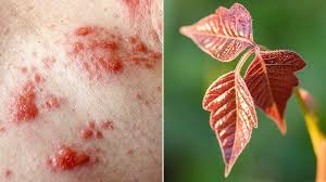 What is the best natural remedy for poison ivy? 8 Tips For Getting Rid Of Poison Ivy On Your Property Everyday Health