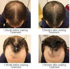 Great Hair Care Advice That Anyone Can Use Hair Loss Remedies Hair Care Advice Hair Loss Regrowth