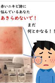 バルクオムを使用した私の口コミ 赤いニキビ跡に効果のある使い方を徹底解説 ニキビ跡 ニキビ ニキビケア