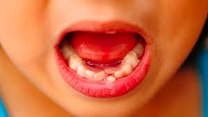 If you are planning to have your tooth pulled by this method then go to a dentist instead. How To Pull A Tooth At Home Knoxville Family Dentistry