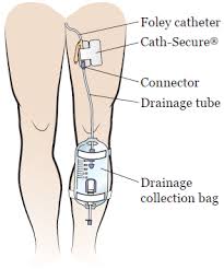 Caring For Your Urinary Foley Catheter Memorial Sloan Kettering Cancer Center