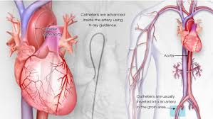 Pin On Cardiac Cath Lab Nursing