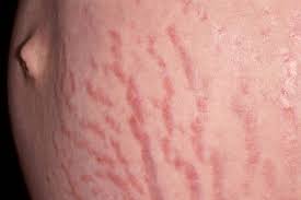 Image result for pruritic urticarial papules and plaques of pregnancy