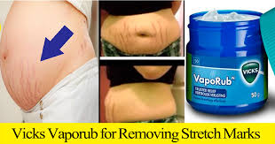 How To Use Vicks Vaporub For Removing Stretch Marks