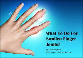 Pin On Arthritis Hands
