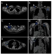 1 ,  2 Healthcare Free Full Text The Findings Of Spect Ct Concerning Bypass Lymph Circulation In Lymphedema Following Breast Cancer Surgery Html