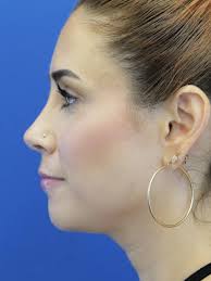 Cases in Rhinoplasty Bridge Only