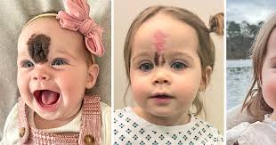 Parents Sent Daughter to Surgery to Remove Rare Birthmark, “People Would  Stare at Her”