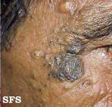 Nodular elastosis with cysts and comedones of favre and racouchot (111200005). Favre Racouchot Syndrome Wikidoc