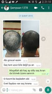 110 Gun Civari Kulanan Sac Kiran Binox Sac Cikaran Mavi Su Serum Ve Sampuan Losyon Ilac Facebook