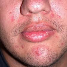 I would first start off with a benzoyl peroxide gel, it's otc and cheap at the drugstore. Treating Acne In Adult Males