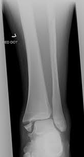 Take another look at the mortise view: The Ankle
