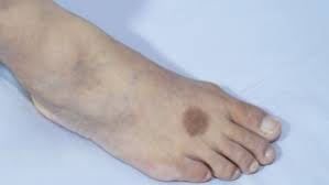 Image result for Pigment stains on the shin
