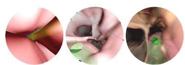 Image result for Virtual Endoscopy