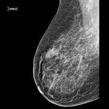 Mammographie Radiologie Rhein Neckar De