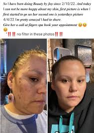 My advanced facials are more than just relaxation: This is an actual post  from one of my loyal clients. The before and after pictures are only TWO  MONTHS APART! She had zero