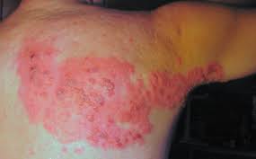 Bältros är en virusinfektion som ger hudutslag och blåsor som gör ont. Baltros Hur Man Snabbt Kan Bli Av Med Smartan Med Akupunktur