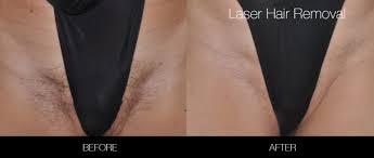Genital hair removal in general is a sensitive topic since the skin on our testicles is sensitive. Brazilian Laser Hair Removal In Toronto Spamedica