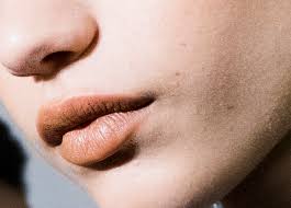 Initial bumps can be due to injection site injury and swelling (not. Swelling Bumps And Bruises What Is Considered Normal When Getting Your Lips Done Newbeauty