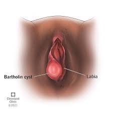 Bartholin Cyst: Causes, Treatment, Symptoms & Removal