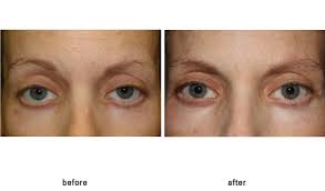 Pin On Blepharoplasty