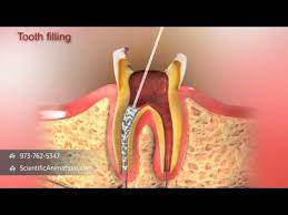 Informal (dental treatment) tratamiento de conducto loc nom m. Root Canal Treatment Youtube