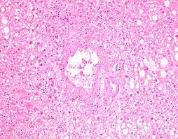 The differential diagnosis in a patient with a swallowing disorder or other problem with food intake includes both local and systemic problems. Pathology Outlines Herpes Simplex Virus Hepatitis