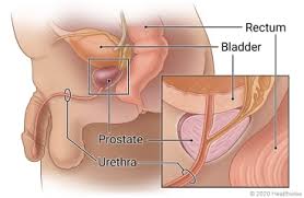 Image result for Radical Prostatectomy