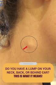 Do You Have A Lump On Your Neck Back Or Behind Your Ear This Is What It Means Hardlumpundermyskin Skin Bumps Lump Behind Ear Itchy Skin