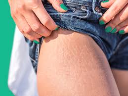 Keep your hands away from the scratch as it heals. 8 Home Remedies For Stretch Marks