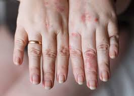 While most allergies can't be cured, treatments can help relieve your allergy symptoms. Laundry Detergent Rash 7 Ways To Treat It Oh So Spotless
