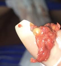 However, there is no natural outlet for the blood carbon dioxide passes from the blood out into the air in the lungs. Miscarriage Tissue Babycenter