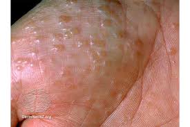 Image result for pompholyx soles of feet