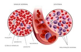 La leucemia se trata, en la mayoría de los casos, con quimioterapia sola, manejada por médicos oncólogos. Leucemia Linfoblastica Aguda Pfizer Portugal