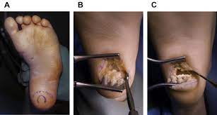 Clubfoot is a deformity in which an infant's foot is turned inward, often so severely that the bottom of the foot faces sideways or even upward. Correction Of The Neglected Clubfoot In The Adolescent And Adult Patient Foot And Ankle Clinics