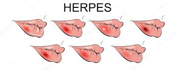 Herpes zoster, also called shingles, is an infection caused by the varicella virus. Vektorgrafiken Herpes Vektorbilder Herpes Depositphotos