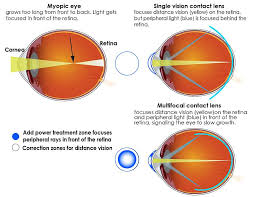 How long does it take for my lenses to arrive? Multifocal Contact Lenses Slow Myopia Progression In Children National Institutes Of Health Nih