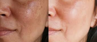 ¿tal vez ha sido más bien la edad o incluso los cambios hormonales? Despidete De Las Manchas Con Estas Recomendaciones Si Se Puede Consulta Nuestras Entradas De Blog