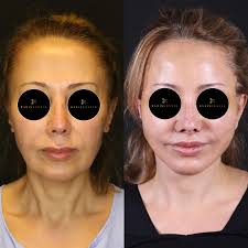 morpheus8, which is also known by different names such as golden needle and  fractional radiofrequency application, is a non-surgical application that  you can safely choose. It is highly effective in skin rejuvenation