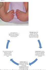 Гена букин кончает в дашу при всей семье (сез1:эп9). Pdf The Ponseti Method For The Treatment Of Congenital Talipes Equinovarus Ctev Semantic Scholar