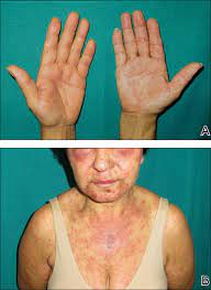 But, if a patient has cirrhosis, then nsaids cannot be taken at all. Dress Syndrome Induced By Telaprevir A Potentially Fatal Adverse Event In Chronic Hepatitis C Therapy Mdedge Dermatology
