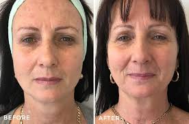 If you answered yes to any of those questions, i'd recommend stopping them for three days before and after you use a peel to minimize irritation. Chemical Peel Before After Images Dr Jeremy Hunt Sydney