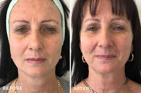 If you answered yes to any of those questions, i'd recommend stopping them for three days before and after you use a peel to minimize irritation. Chemical Peel Before After Images Dr Jeremy Hunt Sydney