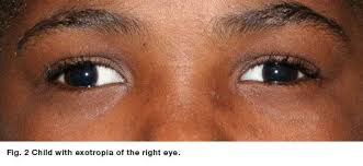 Strabismus Eczema Treatment Fungus Treatment Eye Exercises