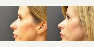 Lewis Albert Andres, MD, Board Certified Plastic Surgeon