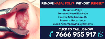 Depending on how big the nasal polyps are, some would prefer to have their treatments via nasal sprays or medicine. Nasal Polyps Natural Treatment Make Them Fall Off Painlessly Live Positive Multi Speciality Homeopathy