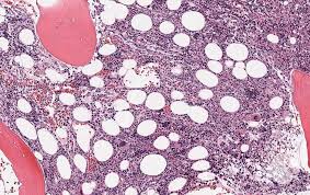 Image result for Bone Marrow Exam